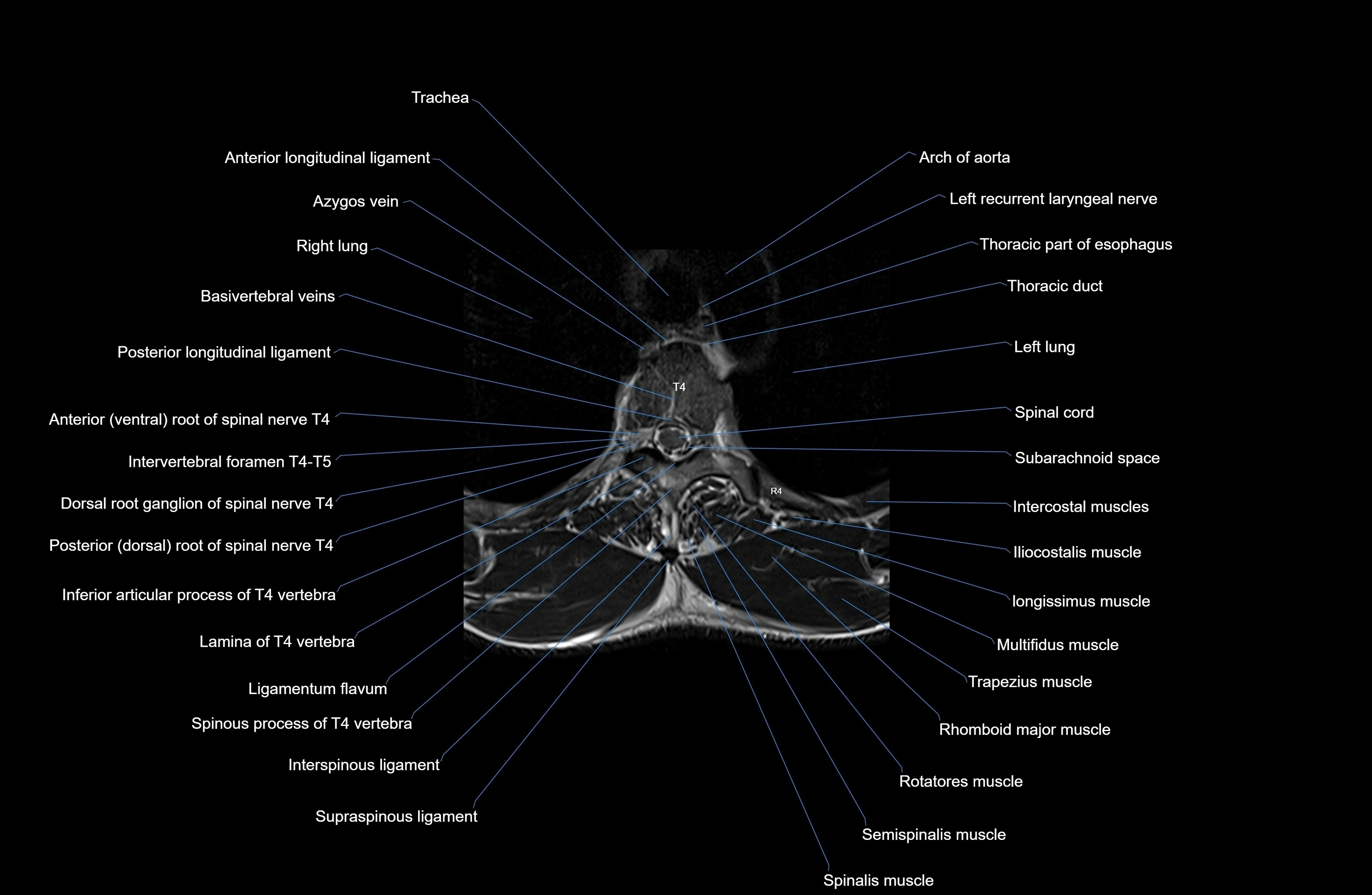 MRI thoracic spine axial  cross sectional anatomy 3T radiology  image-img-00001-00026.webp